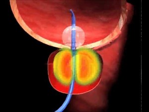 Cooled ThermoTherapy Procedure Animation