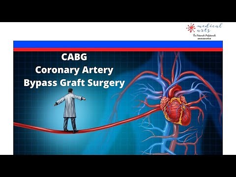 Open Heart - CABG Surgery - Coronary artery bypass graft - ON vs OFF pump OR. 4K