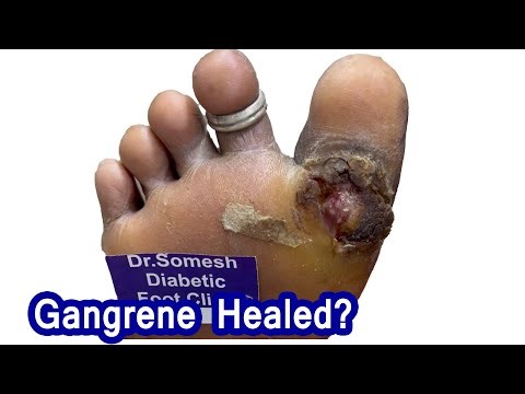 Great Toe #callus turned gangrene healed? #diabeticfoot