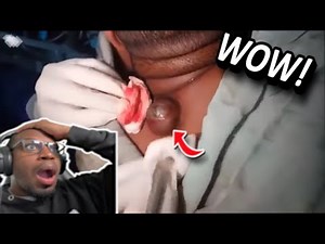 The CRAZIEST PIMPLE POPPING Compilation I Have EVER SEEN! | Pimple popping and Blackhead Compilation