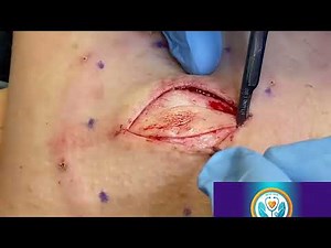 Calcified Cyst Removal on Finger: Full Excision Surgery and Before/After Results