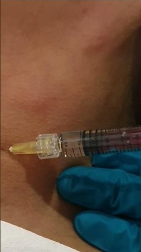 Ejal 40 treatment for Neck 😍🤩 #ejal40 #injectables #skinboosters #aesthetic #Aesthetics