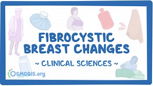 Fibrocystic breast changes: Video & Meaning | Osmosis