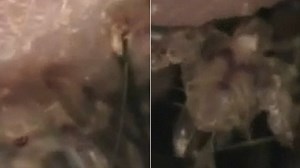 Skin-crawling video of boy with pubic lice in his eyelashes