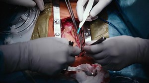 Team of two doctors men surgeons processing surgical operation using endoscopic medical instruments in sterile operating room hospital emergency surgery procedure with anesthesia saving patient life