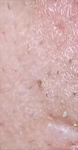 Satisfying Blackhead Removal