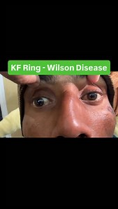 KF Ring (Kayser–Fleischer Ring) in Wilson Disease | Classic Eye Sign of Wilson Disease”| #wilsondisease #kfringineyes #copperdeposition #bestneurologistindehradun #drsorabhgupta | Dr. Sorabh Gupta DM Neurologist, Dehradun