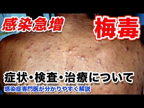 梅毒の症状 写真、検査方法、治療法、予防について【感染症専門医が詳しく解説】