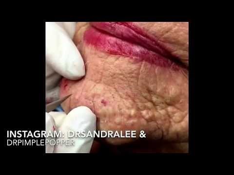 Updated version of milia & blackheads TNTC: 1st treatment. For medical education- NSFE.