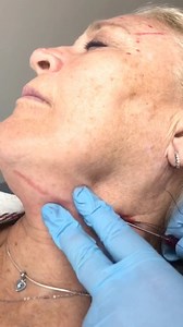 PDO therapy is an effective cosmetic technique that lifts and...