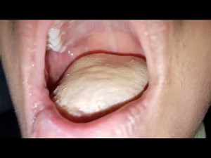 thick white tongue very severe oral thrush oral candidiasis in young girl fungal infection