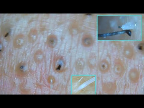 Like trypophobia [plucking facial hair 06/30/21]