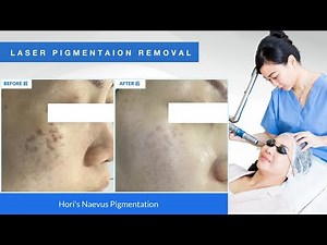 QCS laser has been effective in treating Hori's nevus pigmentation