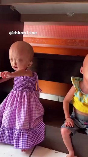 ProgeriaAlso called- Hutchinson-Gilford progeria syndromeA progressive genetic disorder that causes children to age rapidly.The genetic mutation occurs randomly and isn't inherited. #kbkfoundation | Kbkonline