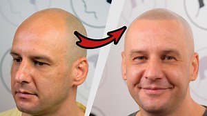 Haarpigmentierung von Patrick bei Haarpigmentierung - Modern Hair Loss Solution Patrick aus Braunschweig ist 41 Jahre alt und seit seinem 25. Lebensjahr mit Haarausfall konfrontiert. Anfangs waren es nur Geheimratsecken, doch mit der Zeit wurden seine Haare immer dünner und er begann, sie zu kaschieren. Trotzdem machte ihm der Haarausfall immer mehr zu schaffen und er suchte im Internet nach Lösungen. Für eine Haartransplantation war Patrick aufgrund seines fortschreitenden Haarausfalls jedoch n