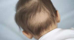 Baby hair loss: When do babies lose their hair?