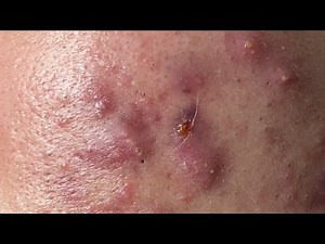 Make your Acne Treatment Huong Da Nang#492 | acne 2022