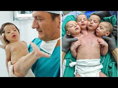 15 Strangest Babies You Won't Believe Actually Exist