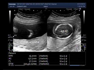 Ultrasound Video showing intrauterine Pregnancy with fetal demise.