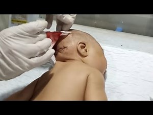 3-Month-Old Baby's Brain Surgery Recovery | Occipital Encephalocele Post-Op Dressing Care