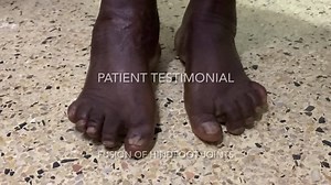 While an extensive fusion for a patient a PanTalar fusion can offer the only avenue for pain relief. | Dr Ezekiel Oburu - Consultant Orthopaedic Surgeon