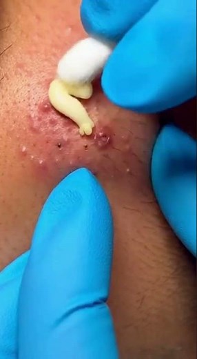 “Big Cystic Acne Removal With Perfect Technique”#CysticAcne #ProfessionalSkincare