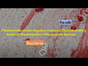 Haemophilus influenzae in Sputum | Coccobacillary forms of Haemophilus influenzae