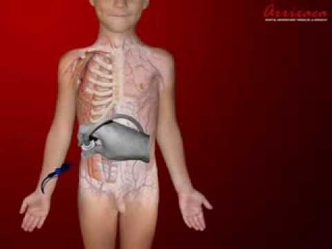 BLOQUEO ILIOINGUINAL-ILIOHIPOGÁSTRICO ECOGUIADO EN PLANO