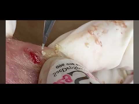 Sacdep Skin - Treatment Of Severe Inflamed Acne #5