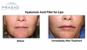 Duck Lips After 1ml  of Juvederm — The Doctor's Recommendation for This Woman