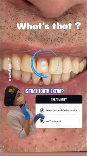 EXTRA TOOTH