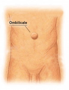 Hernie ombilicale Centre de Chirurgie Viscérale et de l'Obésité Montpellier