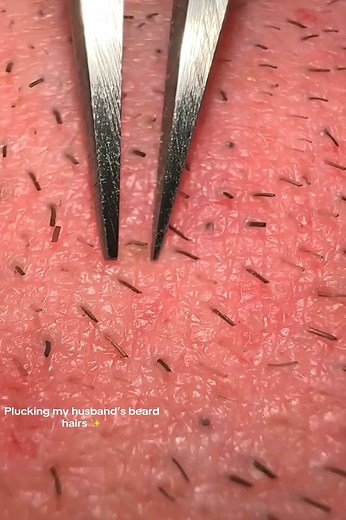 Removal my beard pili multigemini ✌️ #pick #plucking #asmr #beard #multigemini #sebaceousfilament #beardhairplucking #satisfyingvideos #extractions #ingrownhair4 | Lucia Martini