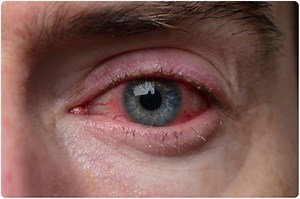 Blepharitis Diagnosis and Treatment