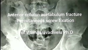 Anterior Column Acetabulum Fracture: Percutaneus Screw Fixation