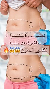 13K views · 96 reactions | Perdez la graisse rapidement de manière confortable et indolore sans régime strict et sans effet secondaire Témoignage de notre chère patiente après une séance de lipolyse Pour toute prise de rendez-vous veuillez nous contacter via : ☎️ 05.53.32.15.73 ☎️07.75.89.88.03  Bouzareah - Alger- #wasa #wasaclinic #medical #esthetique #beauty #beautiful #sans_chirurgie #lipolyse #تكسير_الدهون #algeria #algiers #dz | Dr beroual | Facebook