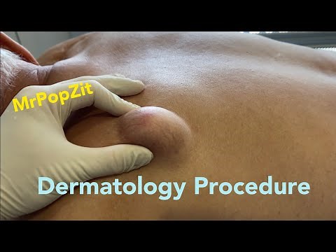 Dermatology procedure on back. MrPopZit.