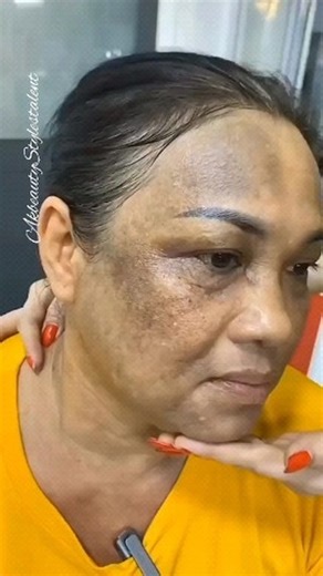 Remove Acne, Dark Spots & Pigmentation Naturally At Home | Get Fair/Glowing Skin 👉Follow @akbeautystylestalent for more. . . . . #darkspots #pigmentation #acne #ridofpigmentation #ridofacne #ridofdarkspots ##skincare #skincareroutine #instagram #trend | Aashi Ak