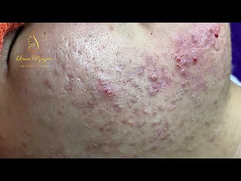 Blackheads Removal (333a) | Loan Nguyen