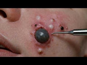 ASMR Satisfying Blackhead Removal | Deep Facial Cleansing Routine
