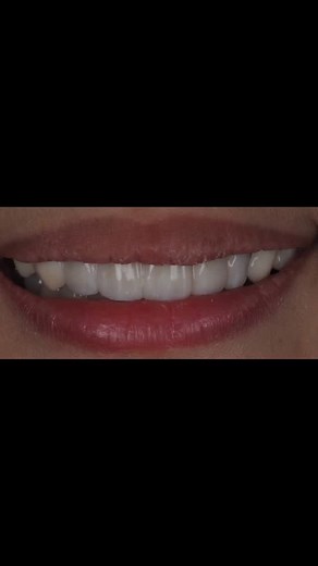 SprintRay Retainer Resin X titanium base for unmatched durability and precision. Retainer resin doubles as a clasp for enhanced support, seamlessly blending strength with crystal-clear aesthetics to ensure a flawless, natural look. Elevate the design with a gold-anodized titanium base, adding a touch of luxury and prosperity inspired by '来财' (welcoming wealth) 💎✨ #SprintRay #DentalInnovation #RetainerResin #TitaniumBase #GoldAnodizing #八方来财 #digitaldentistry #castpartial #dentalmalaysia #3dprin