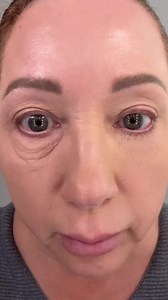 Learn broadly about Eye Bag Removal | All For Your Home