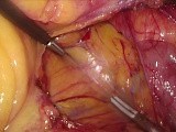 Full-length - Laparoscopic Right Hemicolectomy for Cecal Cancer, Complete Mesocolic Excision (CME) • Video • MEDtube.net