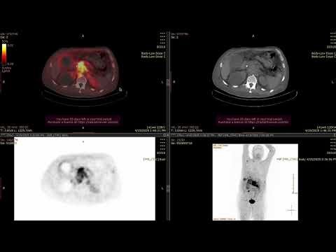 FAPI PET/CT scan in pancreatic cancer