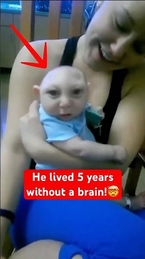 The AMAZING Story of a Baby Born Without a Brain