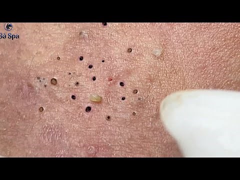 It's So Amazing Blackheads | Part 3 | GaSpa 02.03.2022