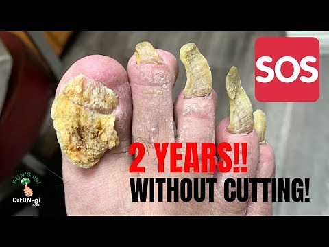GRINDING DOWN LONG AND THICK NAILS