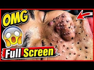 OMG! Extreme Blackheads Removal 😱 | Satisfying Acne Treatment Full Screen#blackheads #acne