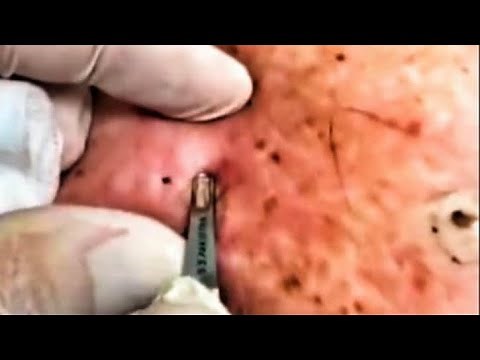 9 Minutes Of Pimple Popping! 23 Zits, Acne and Blackhead Pops