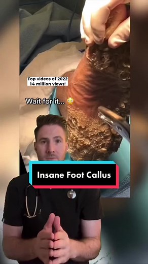 Worst Foot Calluses Ever! Shocking Footage